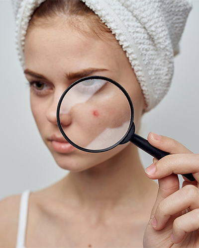 Vitamin E for Acne: Is It Effective?