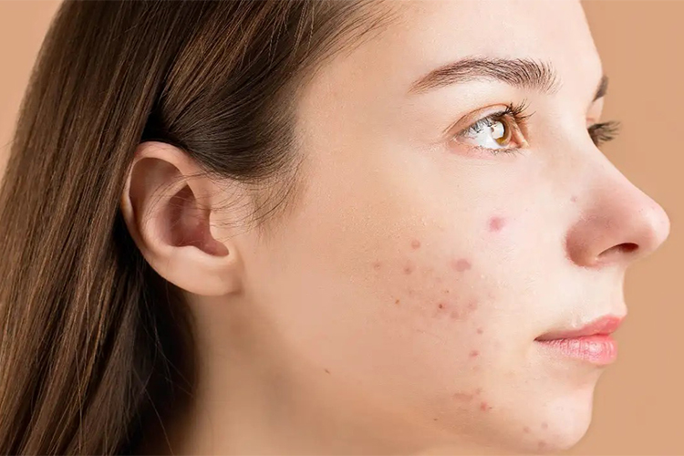 Vitamin E for Acne: Is It Effective?