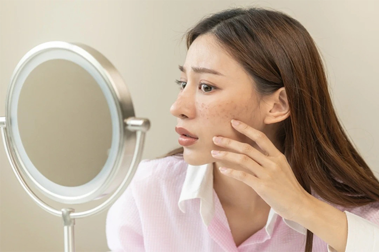 Uneven Skin Tone: Treatments, Home Remedies and Treatment Tips