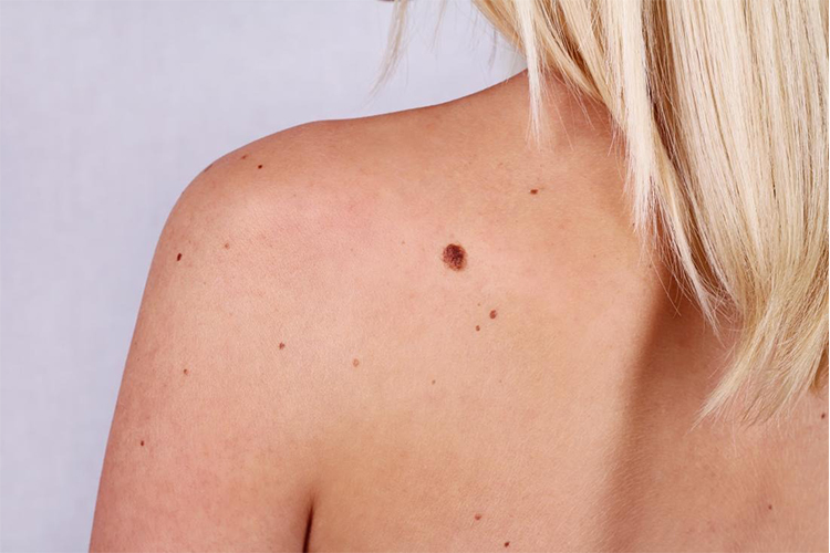 How to remove moles with castor oil